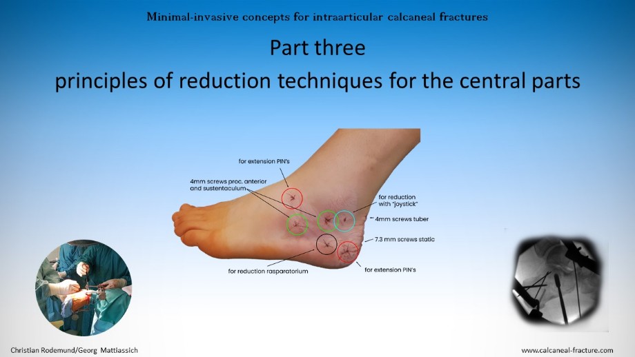 Stress fractures treatment in Washington D.C., Maryland, and Northern  Virginia