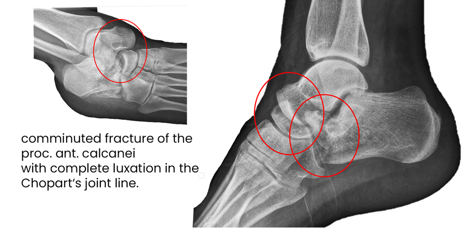 Medial Malleolus Fracture and Broken Ankle Treatment