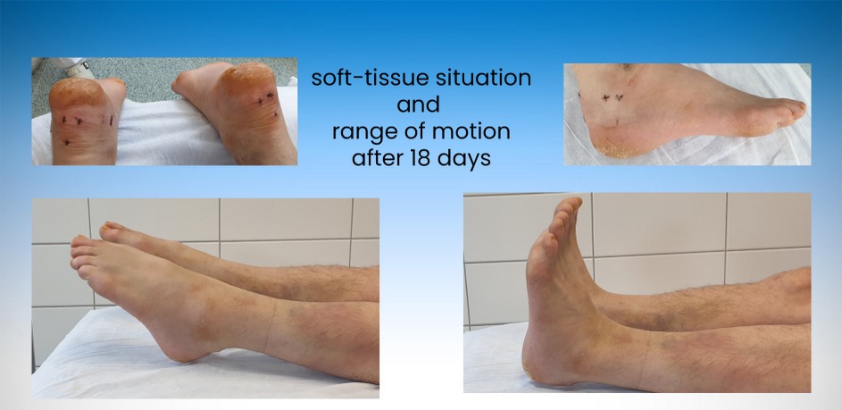 calcaneus fracture orthobullets calcaneus fracture orthobullets